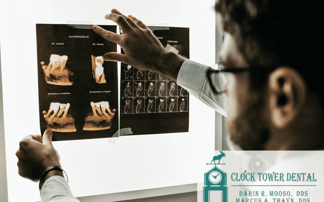 A dentist placing x-rays of the back two molars onto a lightboard for viewing.